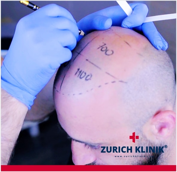 Haaranalyse Haarlinie Zurich Klinik Istanbul Türkei - Beste Haar Klinik Haaranalyse Haarlinie Zurich Klinik Istanbul Türkei - Beste Haar Klinik