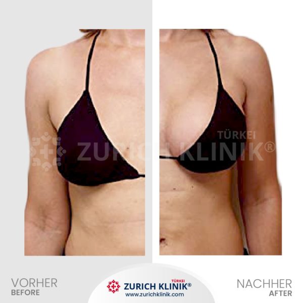 Brustvergrösserung - Brust OP - Zürich Klinik Istanbul Türkei (1)-- Brustvergrösserung - Brust OP - Zürich Klinik Istanbul Türkei (1)--