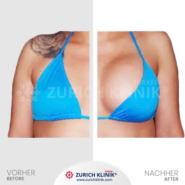 Brustvergrösserung - Brust OP - Zürich Klinik Istanbul Türkei (2)-- Brustvergrösserung - Brust OP - Zürich Klinik Istanbul Türkei (2)--
