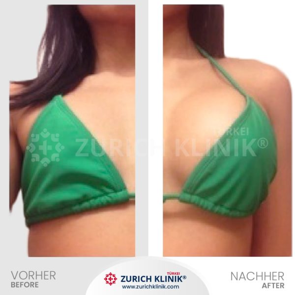 Brustvergrösserung - Brust OP - Zürich Klinik Istanbul Türkei (3)-- Brustvergrösserung - Brust OP - Zürich Klinik Istanbul Türkei (3)--