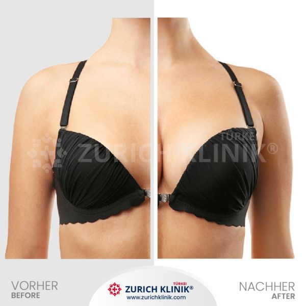 Brustvergrösserung - Brust OP - Zürich Klinik Istanbul Türkei (4)-- Brustvergroesserung Brust OP Zuerich Klinik Istanbul Tuerkei 4