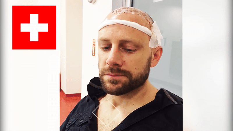 Haartransplantation Zürich Klinik Internation Zürich Istanbul Türkei erfahrungsbericht bewertung 3